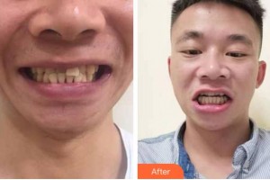 杭州口腔醫(yī)院陳丹鵬整形價(jià)格表附牙齒隱形矯正案例展示