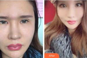 杭州愛(ài)爾眼科醫(yī)院金曉紅整形價(jià)格表附眼部修復(fù)案例展示