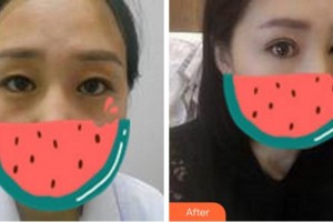 杭州愛(ài)爾眼科醫(yī)院楊羿整形價(jià)格表附切開(kāi)雙眼皮案例展示