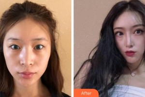 杭州西湖之江眼科醫(yī)院梁遠(yuǎn)波整形價(jià)格表附切開(kāi)雙眼皮案例展示