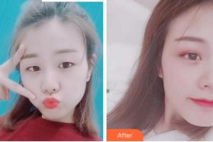 杭州西湖之江眼科醫(yī)院趙向陽(yáng)整形價(jià)格表附眼部綜合案例展示