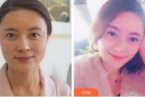 杭州港麗醫(yī)療美容診所童佳奇整形價(jià)格表附切開(kāi)雙眼皮案例展示