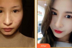 寧波協(xié)和儷人醫(yī)療美容門(mén)診部姜宇祿整形價(jià)格表附眼部綜合案例展示