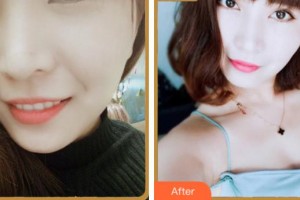 寧波珈禾整形專科醫(yī)院金正旺整形價(jià)格表附眼部綜合案例展示