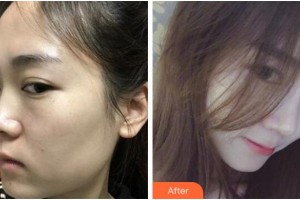 寧波珈禾整形?？漆t(yī)院鮑海萍整形價(jià)格表附膨體隆鼻案例展示