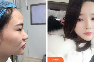 寧波珈禾整形?？漆t(yī)院龔濤整形價(jià)格表附鼻部綜合案例展示