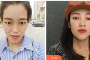 寧波尚麗整形美容醫(yī)院汪蘭主任醫(yī)生整形價(jià)格表附切開(kāi)雙眼皮案例展示