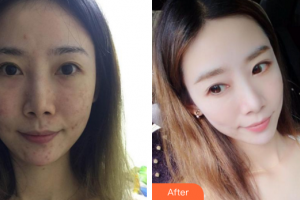 深圳美源醫(yī)療美容門(mén)診部劉金祝整形價(jià)格表附去痘印痘坑案例展示