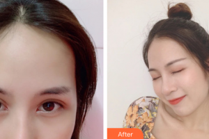 深圳博愛(ài)醫(yī)院整形美容中心白云整形價(jià)格表附眼部手術(shù)案例展示