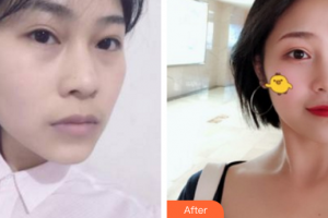 深圳博愛(ài)醫(yī)院整形美容中心賀海風(fēng)整形價(jià)格表附埋線提升案例展示