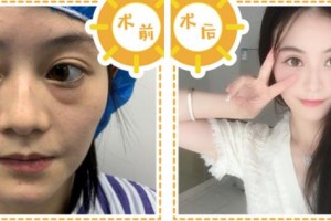 寧波和平博悅美容醫(yī)院尹飛鵬整形價(jià)格表附埋線提升案例展示