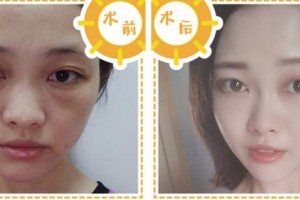 寧波協(xié)和儷人醫(yī)療美容門(mén)診部丁芳芳醫(yī)師整形價(jià)格表附埋線提升案例展示