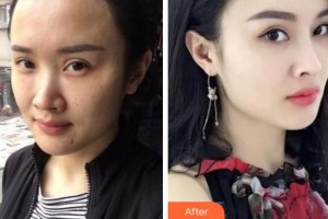 寧波協(xié)和儷人醫(yī)療美容門(mén)診部方振玉整形價(jià)格表附熱瑪吉案例展示