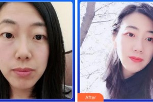 寧波和平博悅美容醫(yī)院金式倫整形價(jià)格表附切開(kāi)雙眼皮案例展示