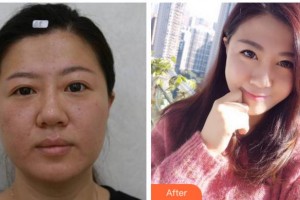寧波佘雨虹醫(yī)療美容診所佘雨虹整形價(jià)格表附埋線雙眼皮案例展示