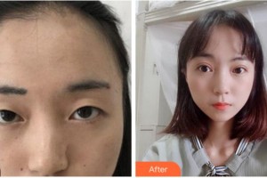 寧波江北口腔醫(yī)院黃觀華整形價格表附切開雙眼皮案例展示