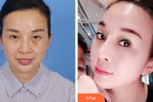 寧波美萊整形美容醫(yī)院張瑋整形價格表附埋線提升案例展示