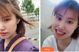 寧波美萊整形美容醫(yī)院金樹人整形價格表附金屬托槽矯正案例展示