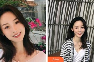 寧波美萊整形美容醫(yī)院田俊整形價格表附金屬托槽矯正案例展示