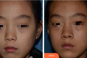 寧波壬美醫(yī)療美容醫(yī)院徐開勇整形價格表附激光點(diǎn)痣案例展示