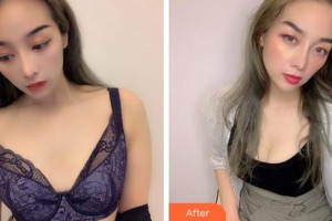 寧波珈禾整形?？漆t(yī)院陳樂琴整形價格表附自體脂肪隆胸案例展示