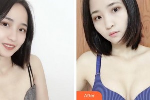 寧波珈禾整形?？漆t(yī)院鄧小榮整形價格表附自體脂肪隆胸案例展示