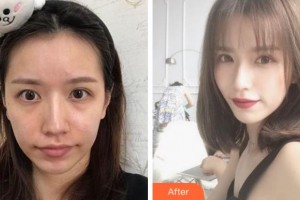 寧波協(xié)和儷人醫(yī)療美容門(mén)診部范軍燕整形價(jià)格表附埋線提升案例展示