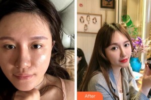 寧波協(xié)和儷人醫(yī)療美容門(mén)診部李曉霞整形價(jià)格表附埋線提升案例展示