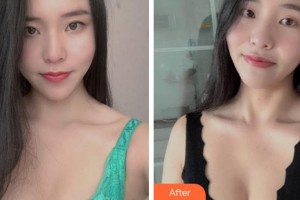 寧波陳標(biāo)新整形美容醫(yī)院催恒碩整形價(jià)格表附自體脂肪隆胸案例展示