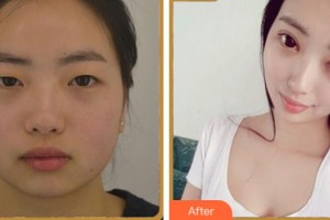 寧波陳標(biāo)新整形美容醫(yī)院白惠媛整形價(jià)格表附眼部綜合案例展示