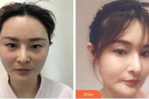 寧波美仁整形美容醫(yī)院柳杬敏整形價(jià)格表附埋線提升案例展示
