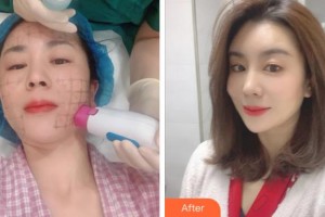 寧波薇琳醫(yī)療美容門(mén)診部盧仁鎬整形價(jià)格表附熱瑪吉案例展示