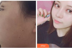 寧波徐建國(guó)美容整形醫(yī)院徐建國(guó)整形價(jià)格表附眼部綜合案例展示