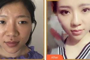 寧波雅韓醫(yī)療美容醫(yī)院劉成林整形價(jià)格表附眼部綜合案例展示