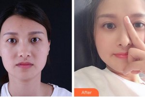 寧波初美醫(yī)療美容診所盧燕明整形價(jià)格表附眼部綜合案例展示