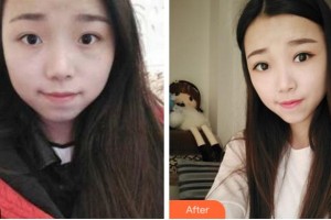 寧波明州醫(yī)院整形美容中心周惠能整形價(jià)格表附切開(kāi)雙眼皮案例展示