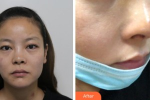 寧波復(fù)大皮膚病?？漆t(yī)院江海鵬整形價(jià)格表附鼻部綜合案例展示