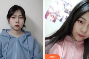 寧波復(fù)大皮膚病?？漆t(yī)院武文帥整形價格表附埋線提升案例展示