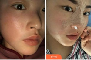 寧波和平博悅美容醫(yī)院汪發(fā)生整形價格表附鼻部綜合案例展示