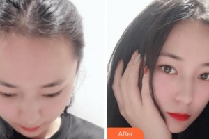 寧波云錦秀醫(yī)療美容診所吳劍華整形價格表附種植發(fā)際線案例展示