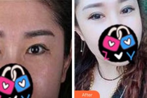 寧波韓美醫(yī)療美容門診部黃艷紅整形價格表附眼部修復(fù)案例展示