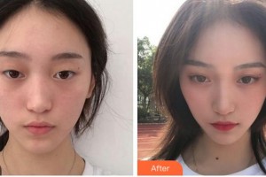 寧波鄞州眼科醫(yī)院周艷整形價格表附眼部綜合案例展示