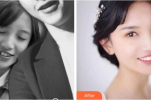 寧波江北口腔醫(yī)院柱整形價格表附金屬托槽矯正案例展示