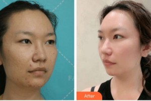 寧波美塑醫(yī)療美容門診部湯朝陽整形價格表附切開雙眼皮案例展示