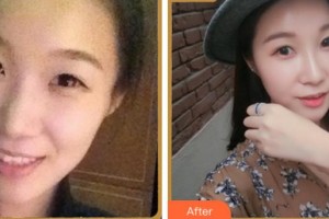 寧波美塑醫(yī)療美容門診部王學(xué)軍整形價格表附熱瑪吉案例展示