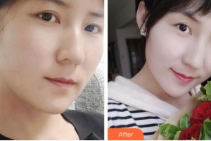 寧波美塑醫(yī)療美容門診部溫志剛整形價格表附埋線提升案例展示