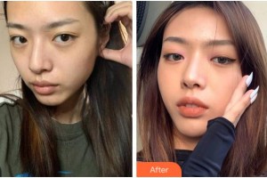 寧波市第六醫(yī)院整形外科周丹亞整形價格表附埋線提升案例展示