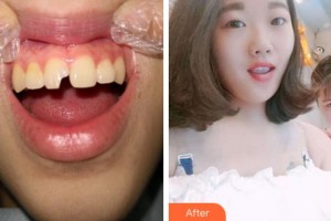 寧波拜博拜爾口腔醫(yī)院吉東整形價格表附美白貼片案例展示