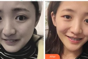 寧波拜博拜爾口腔醫(yī)院吳學(xué)銘整形價格表附金屬托槽矯正案例展示