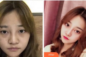 寧波鄞州眼科醫(yī)院陳彥整形價格表附切開雙眼皮案例展示